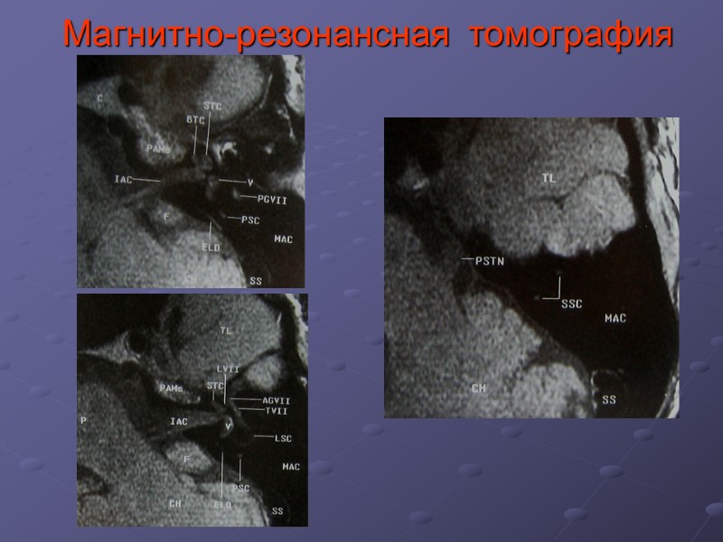 Магнитно-резонансная  томография